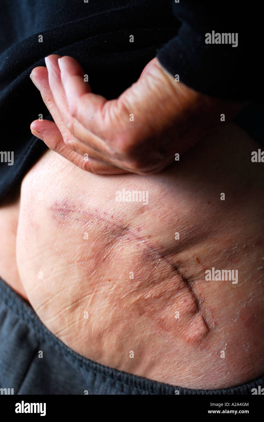 Scar from hip-replacement surgery on elderly man Stock Photo