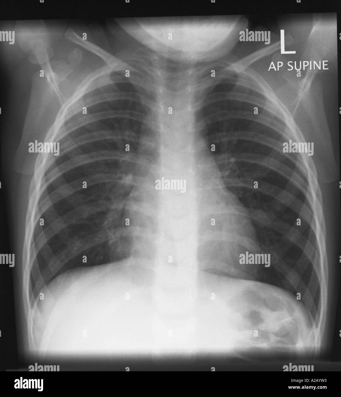 paediatric-chest-x-ray-01-stock-photo-alamy