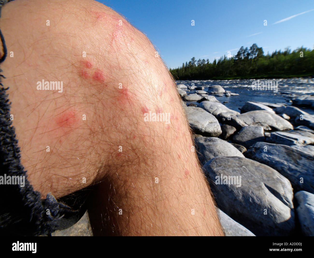 Mosquito bites leg hires stock photography and images Alamy