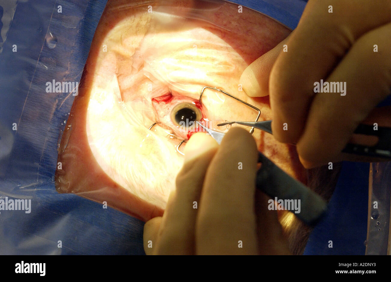 Cataract operation seen in close up in operating theatre Stock Photo
