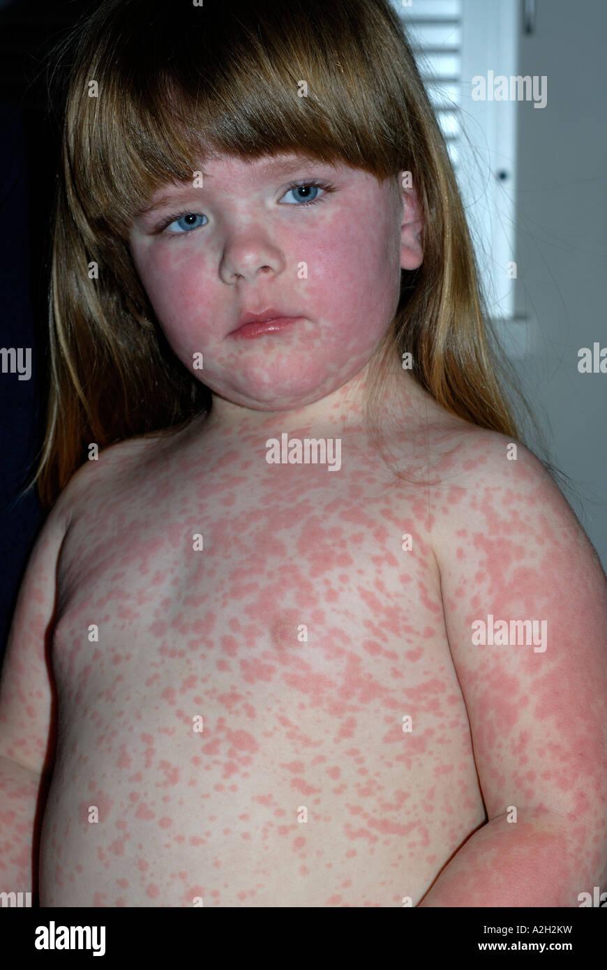 Amoxicillin drug rash on young girl Stock Photo Alamy