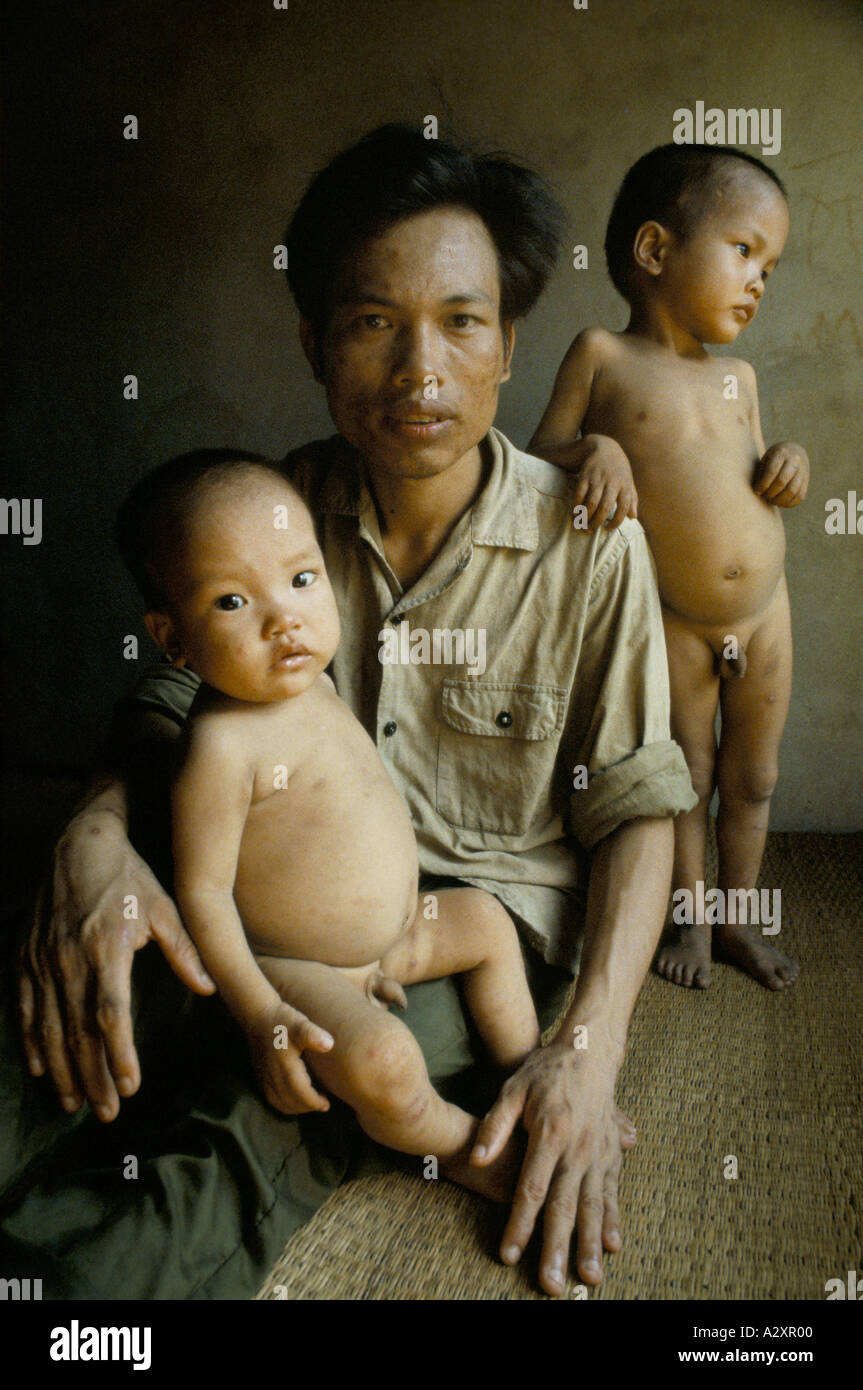 These two boys both have heart defects and their father has Chloracne after being sprayed with Agent Orange Stock Photo