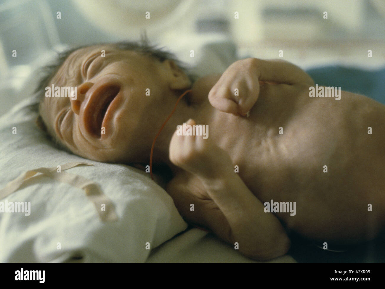 Deformed Baby High Resolution Stock Photography And Images Alamy Deformed Baby High Resolution Stock Photography And Images Alamy