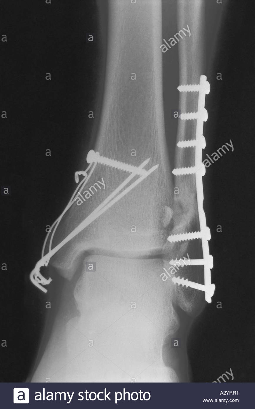 Ankle Fracture Stock Photos & Ankle Fracture Stock Images - Alamy