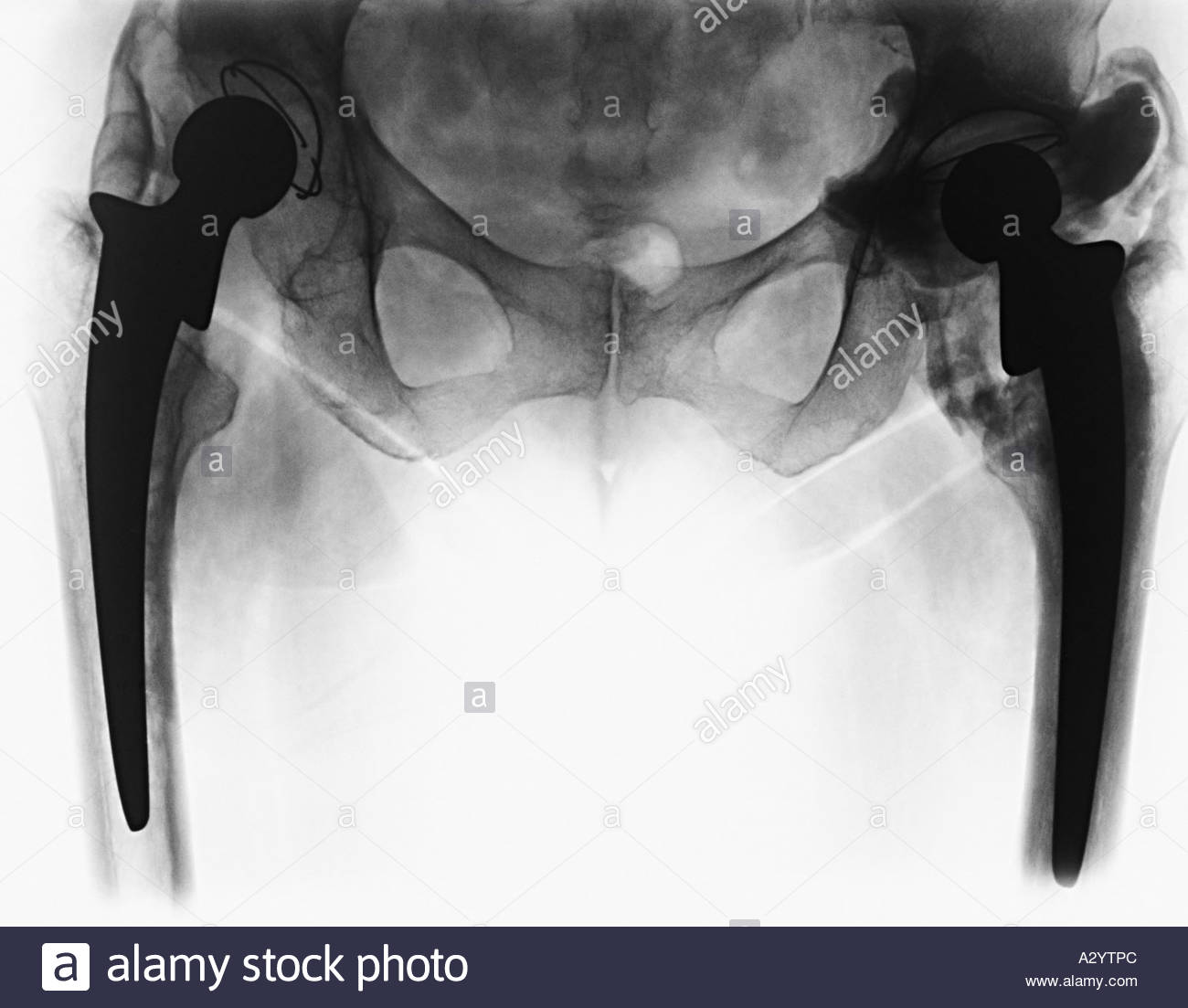 Hip Replacement Xray Stock Photos & Hip Replacement Xray Stock Images