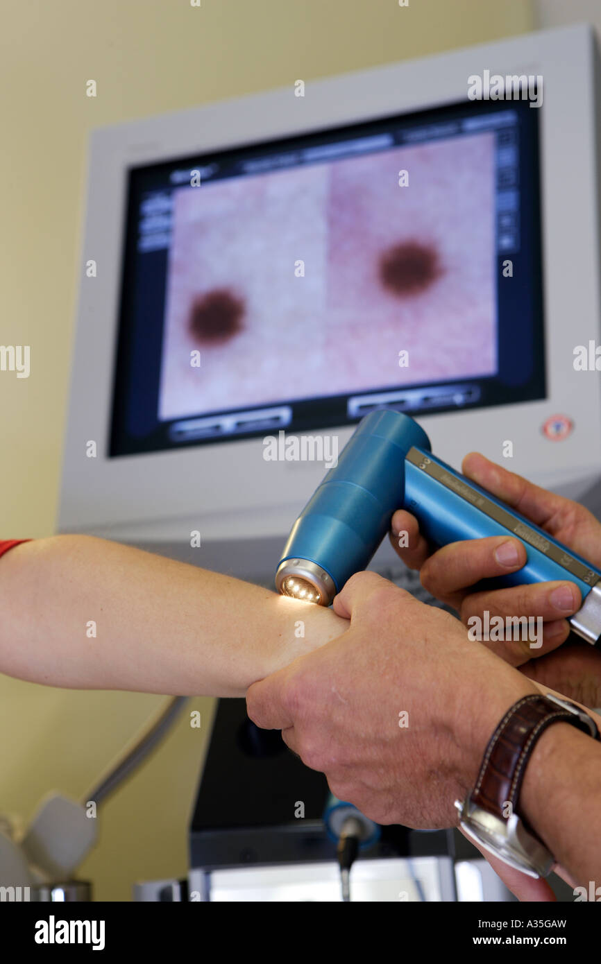 The skin specialist MD Serko von Schmiedeberg examines a patient with a video dermatoscope Stock Photo