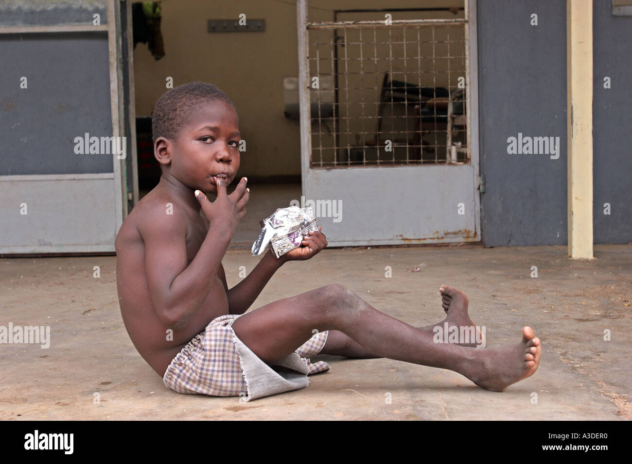 A child who has been receiving food therapy for being malnourished in Lodwar district hospital Stock Photo