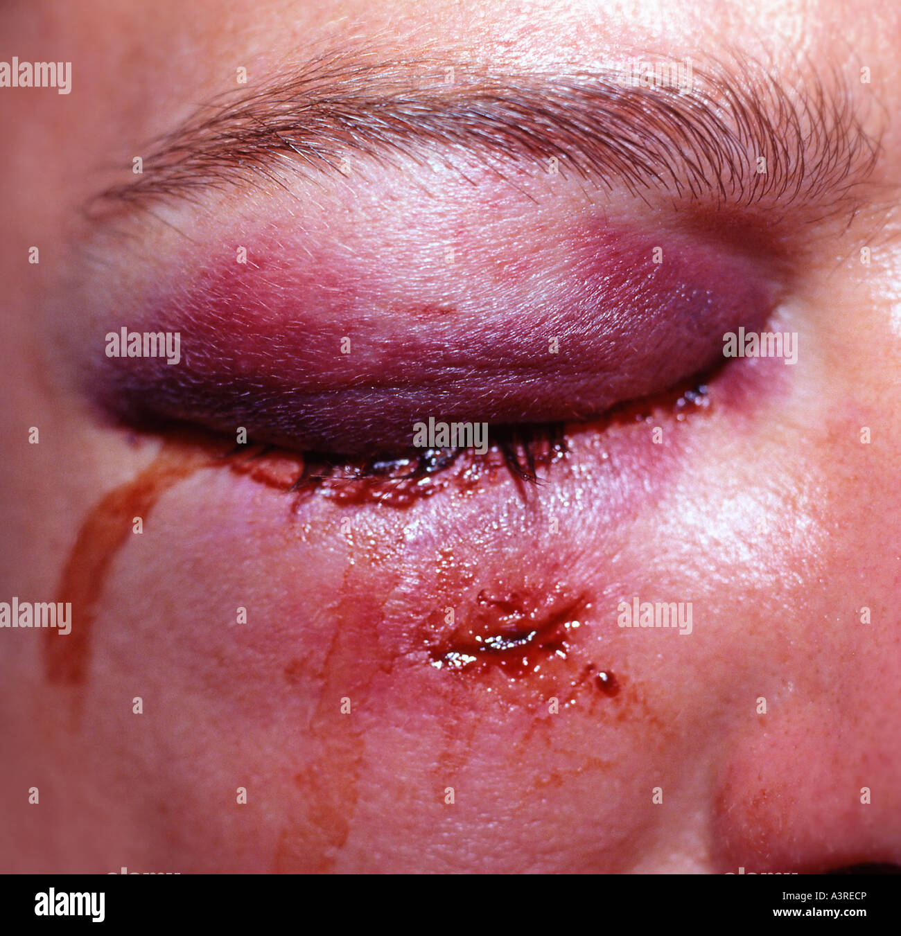 Black eye. Picture by Paddy McGuinness paddymcguinness. Stock Photo
