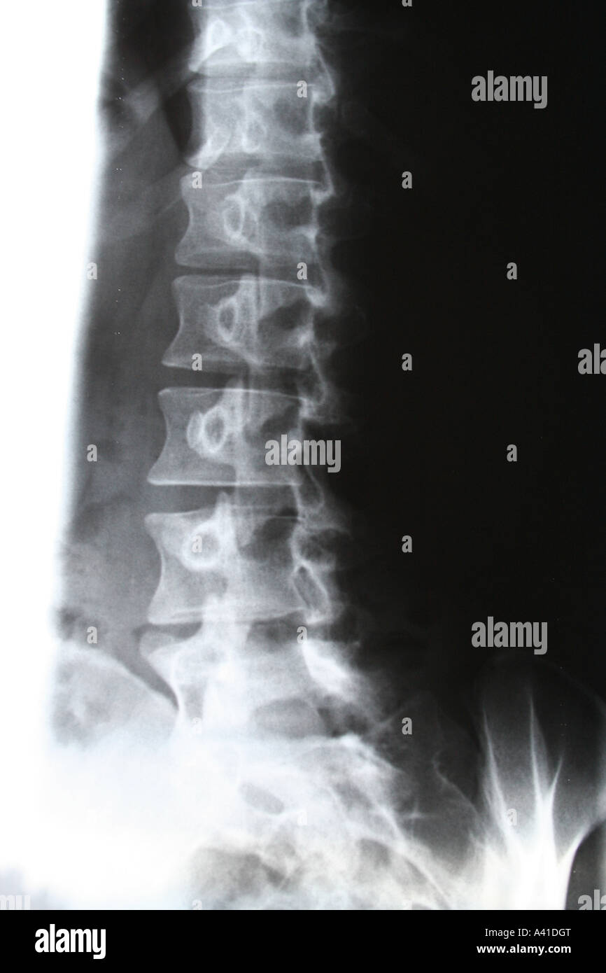 x-ray on spine Stock Photo