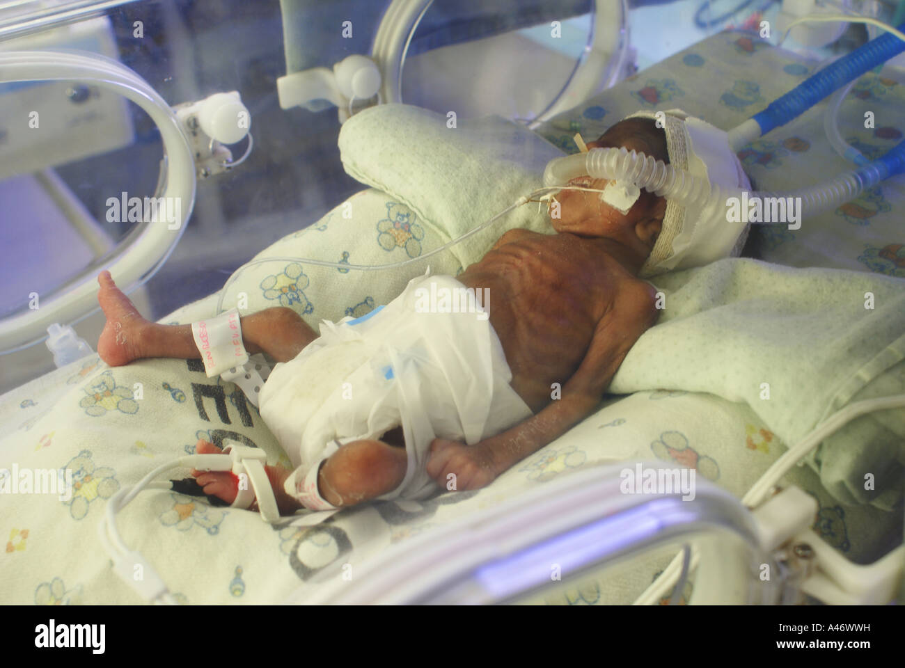 Premature infant at the intensive care, Recife, Brazil Stock Photo