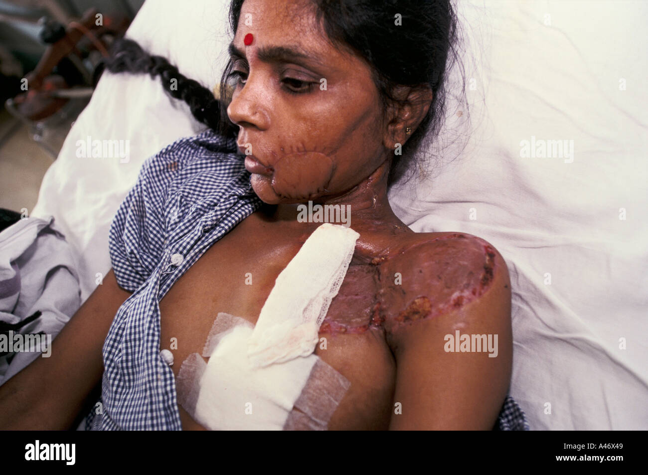 Woman in hospital bed after re-constructive plastic surgery for facial cancer Mumbai (Bombay) India Stock Photo