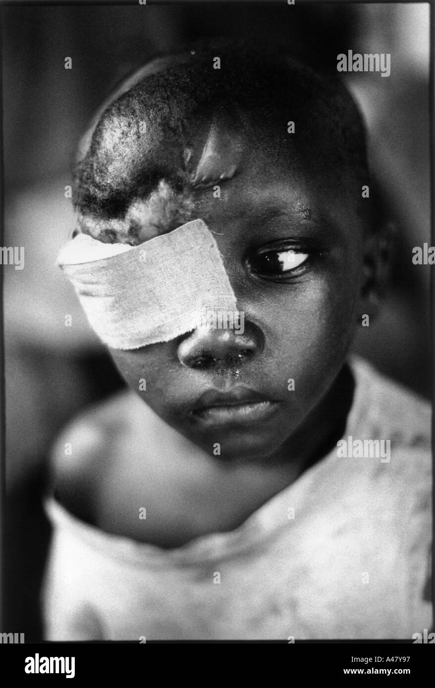 A Hutu boy with a bandage over his right eye due to a grenade attack by rebel forces  waits in hospital in Bujambura, Burundi Stock Photo