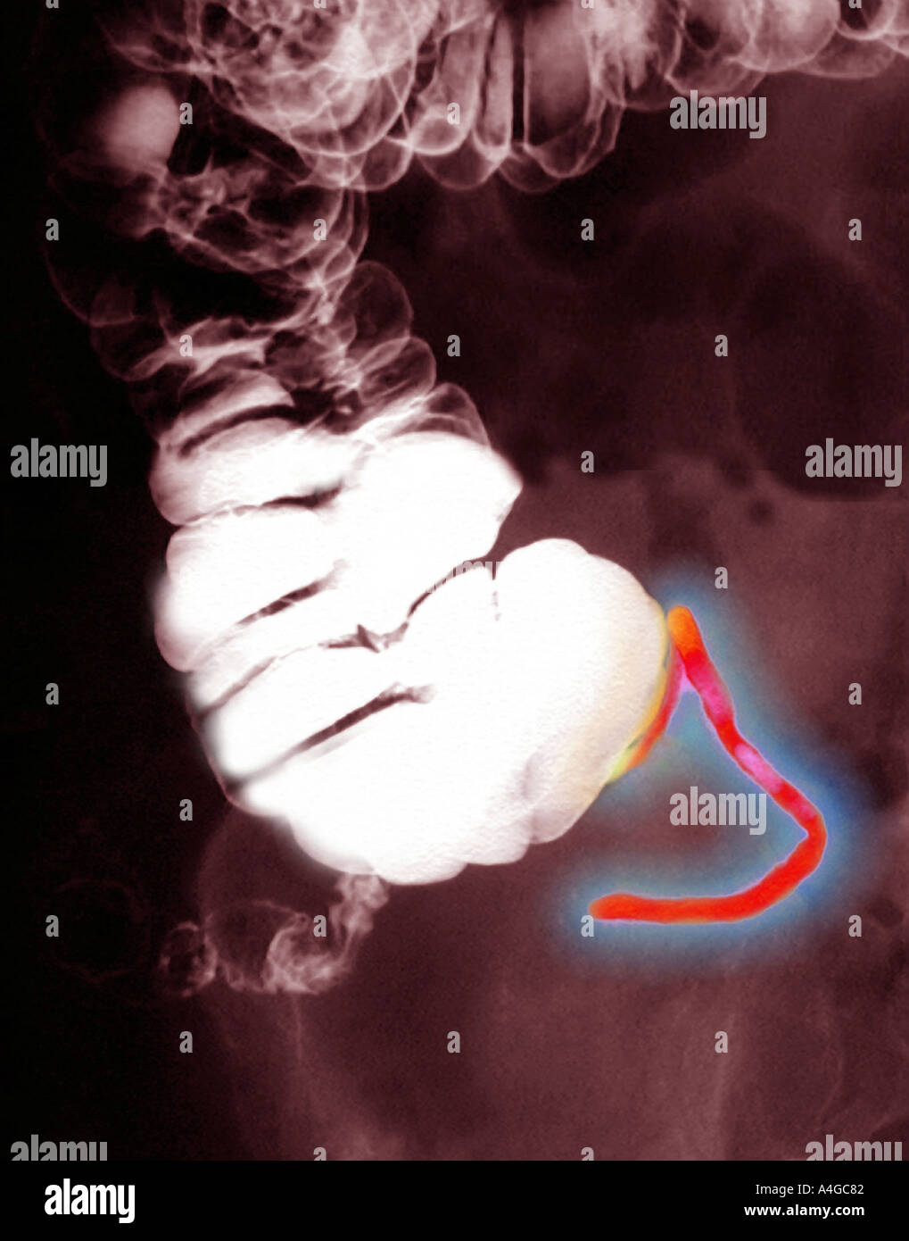 75 year old male barium enema showing a very long appendix Stock Photo ...