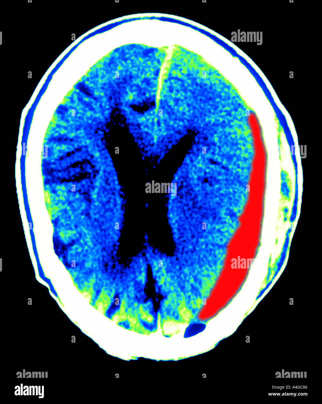 subdural hematoma of the brain Stock Photo