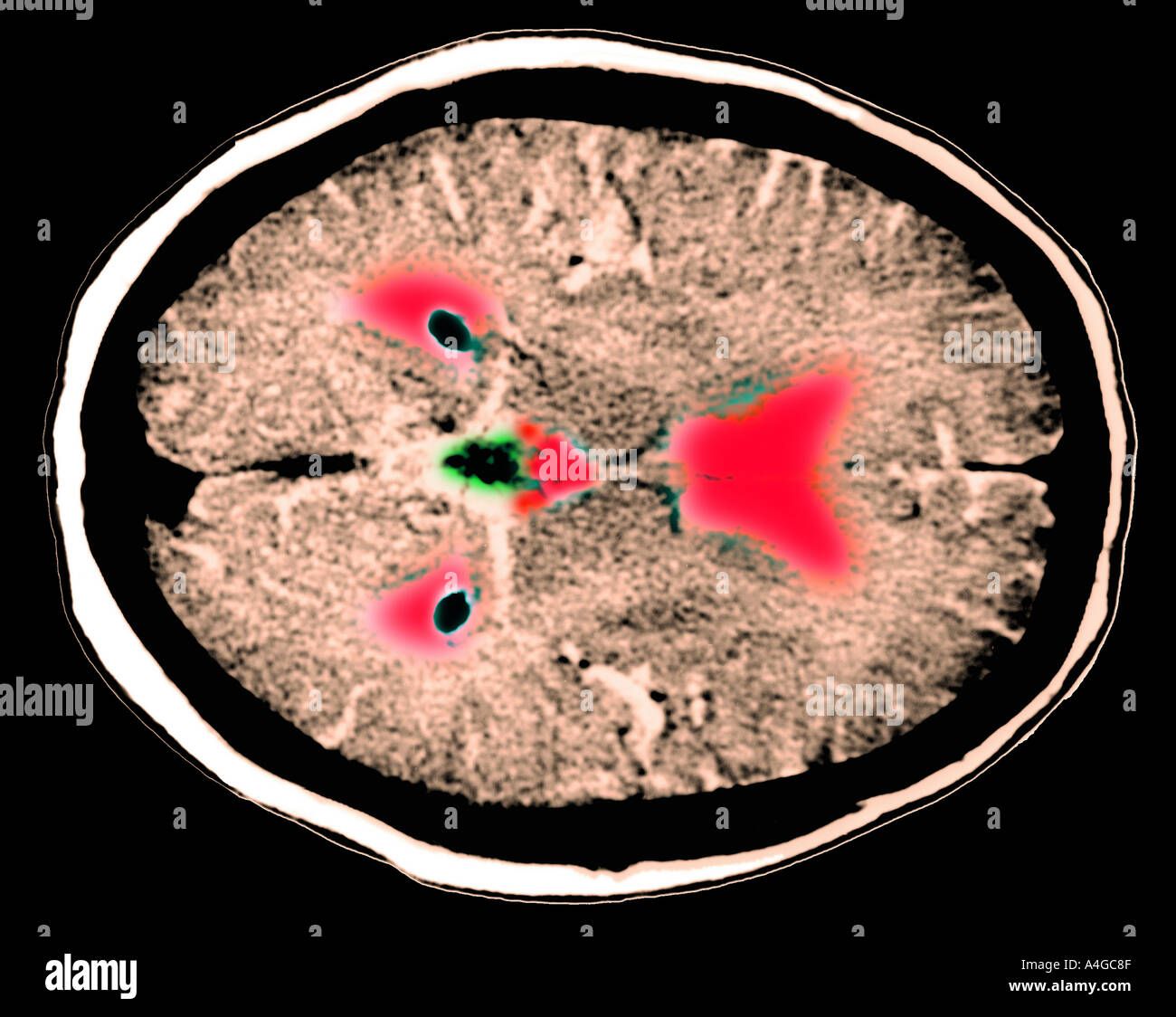 CT of brain showing ventricles and pineal gland  Stock Photo