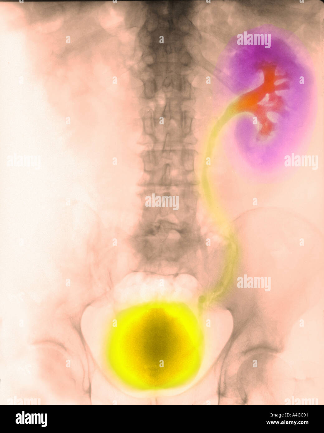 An IVP intravenous pyelogram showing obstruction of a kidney and ...