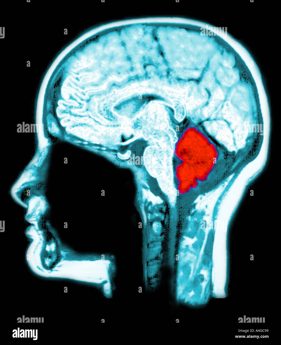 MRI scan of the brain computer enhanced to highlight the cerebellum red  Stock Photo