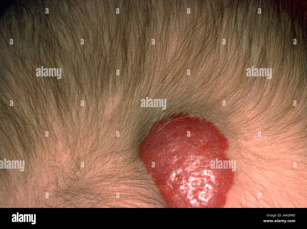 Capillary haemangioma Stock Photo