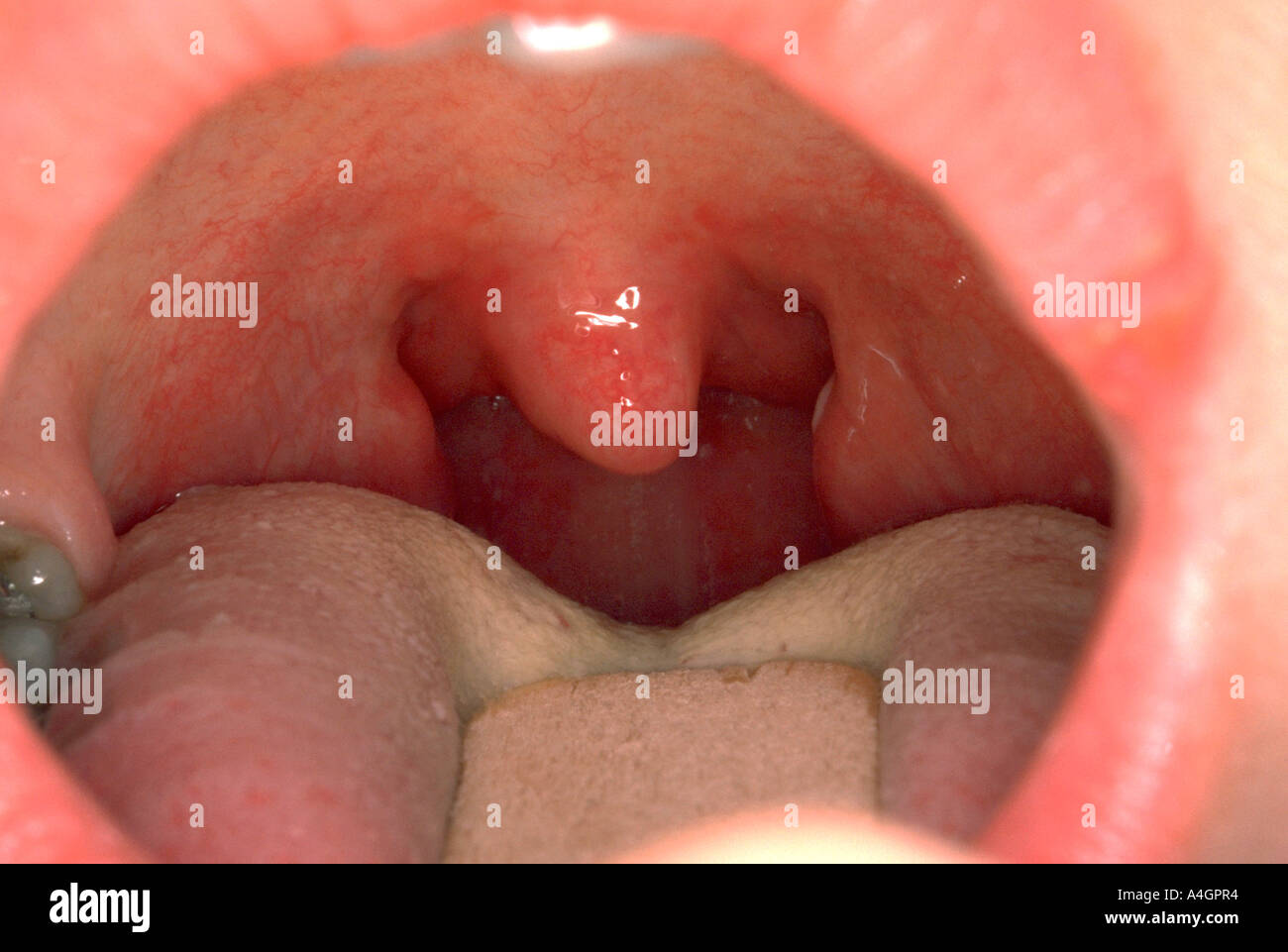 Tonsillitis is a serious disease Tonsillitis is a serious disease