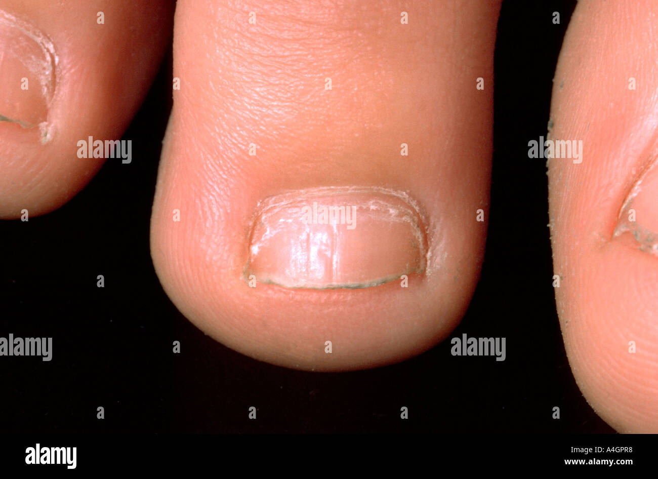 Health From Nails: 10 Fingernail Problems to Watch for | SELF