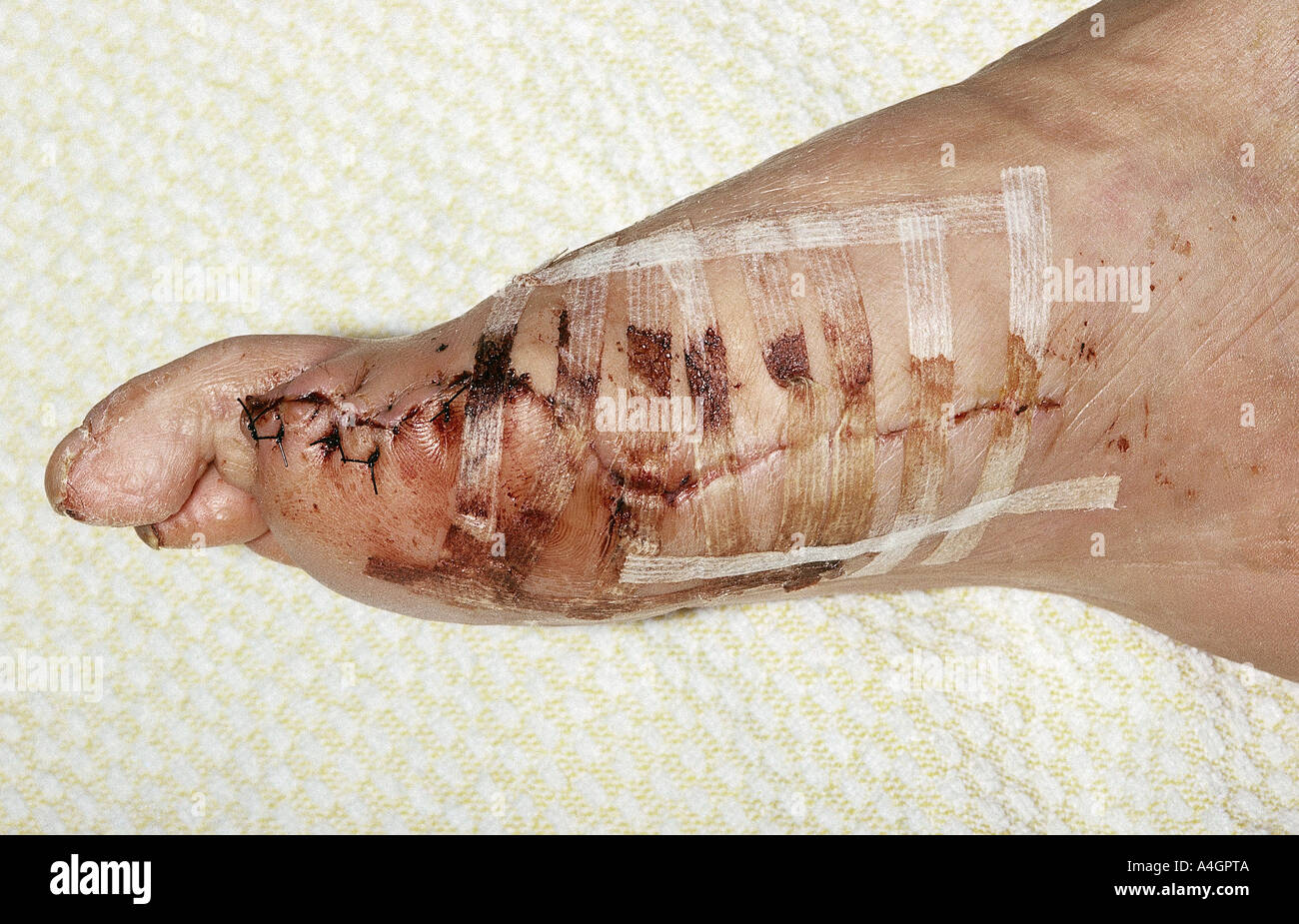 A photograph of the foot of an insulin dependent diabetic patient suffering from cardiovascular complications Stock Photo