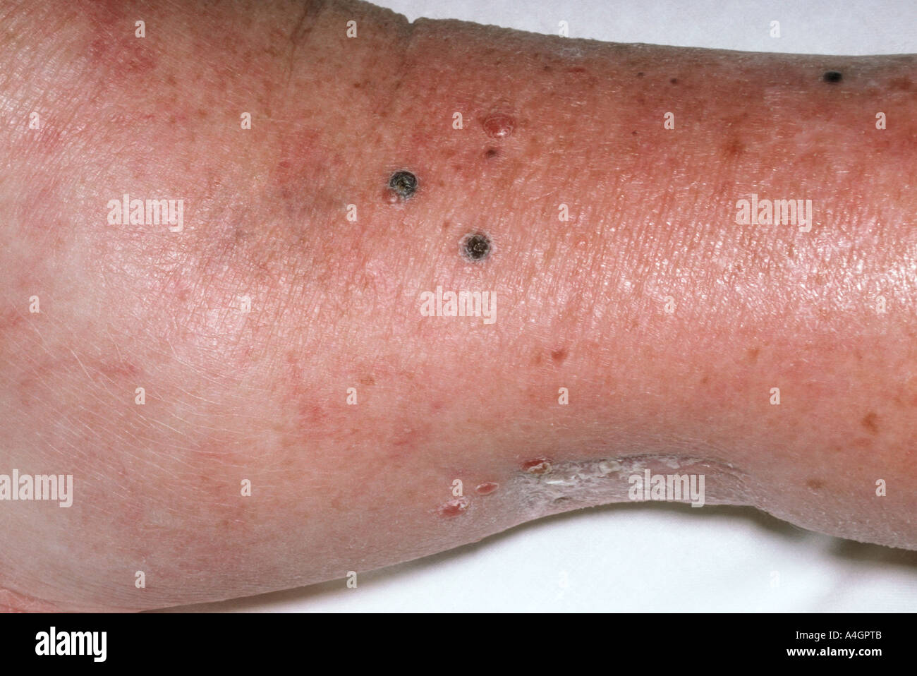 Malignant melanoma is a serious form of skin cancer Stock Photo