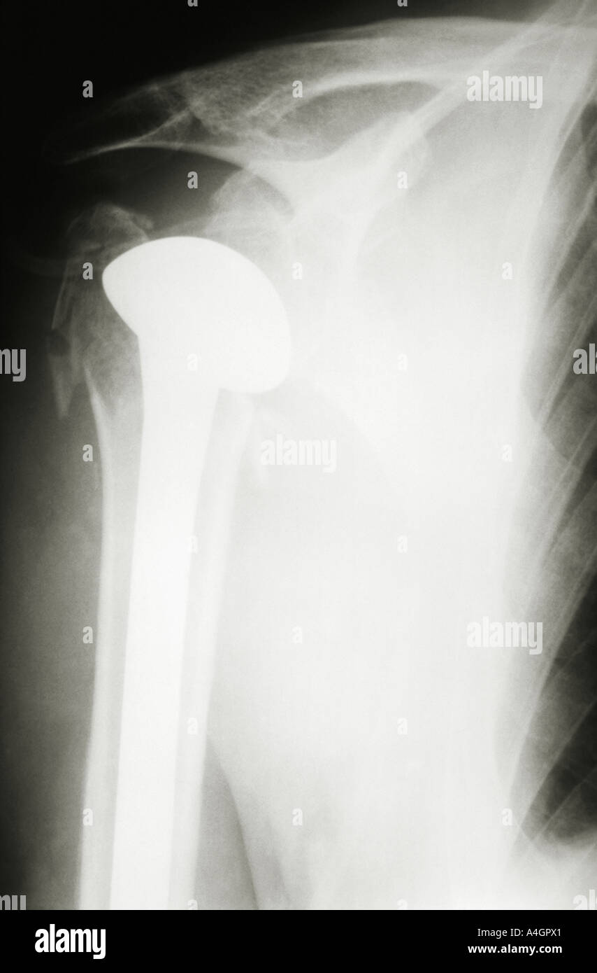 An xray of a fracture dislocation of the shoulder joint repaired using