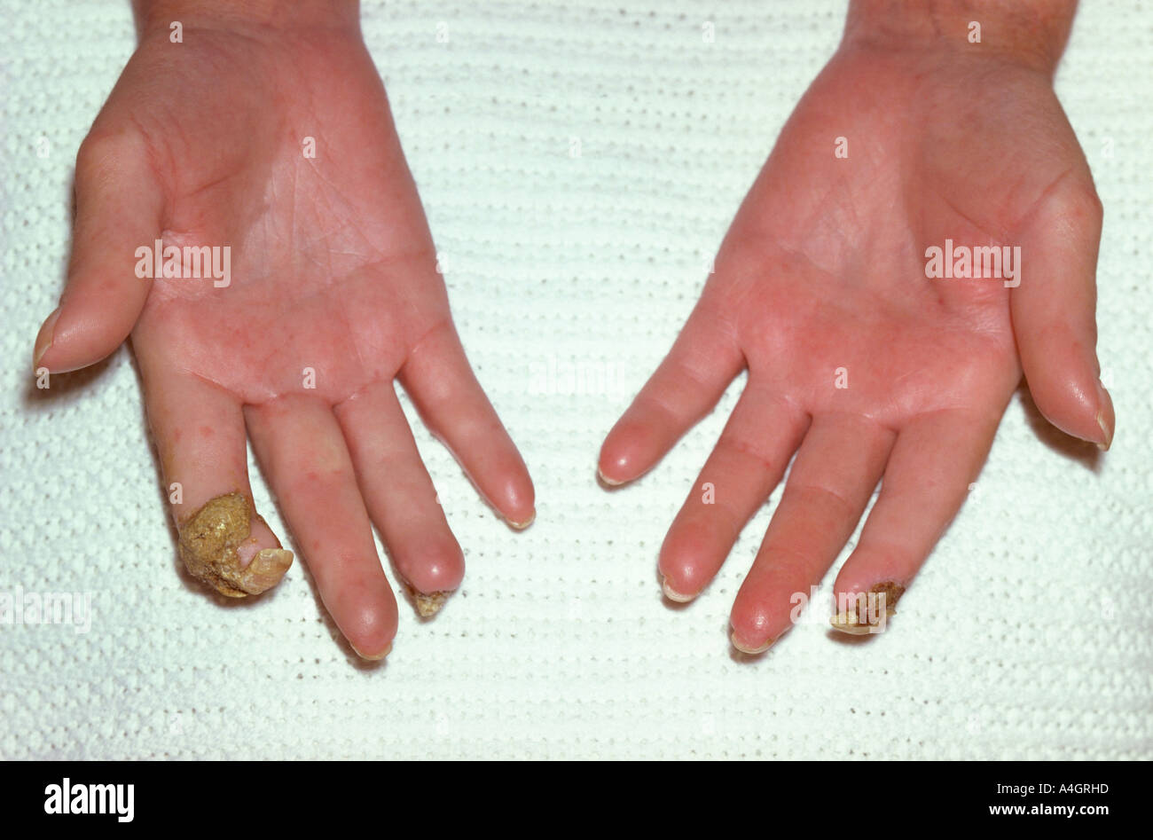 Scleroderma - index finger sequestration Stock Photo