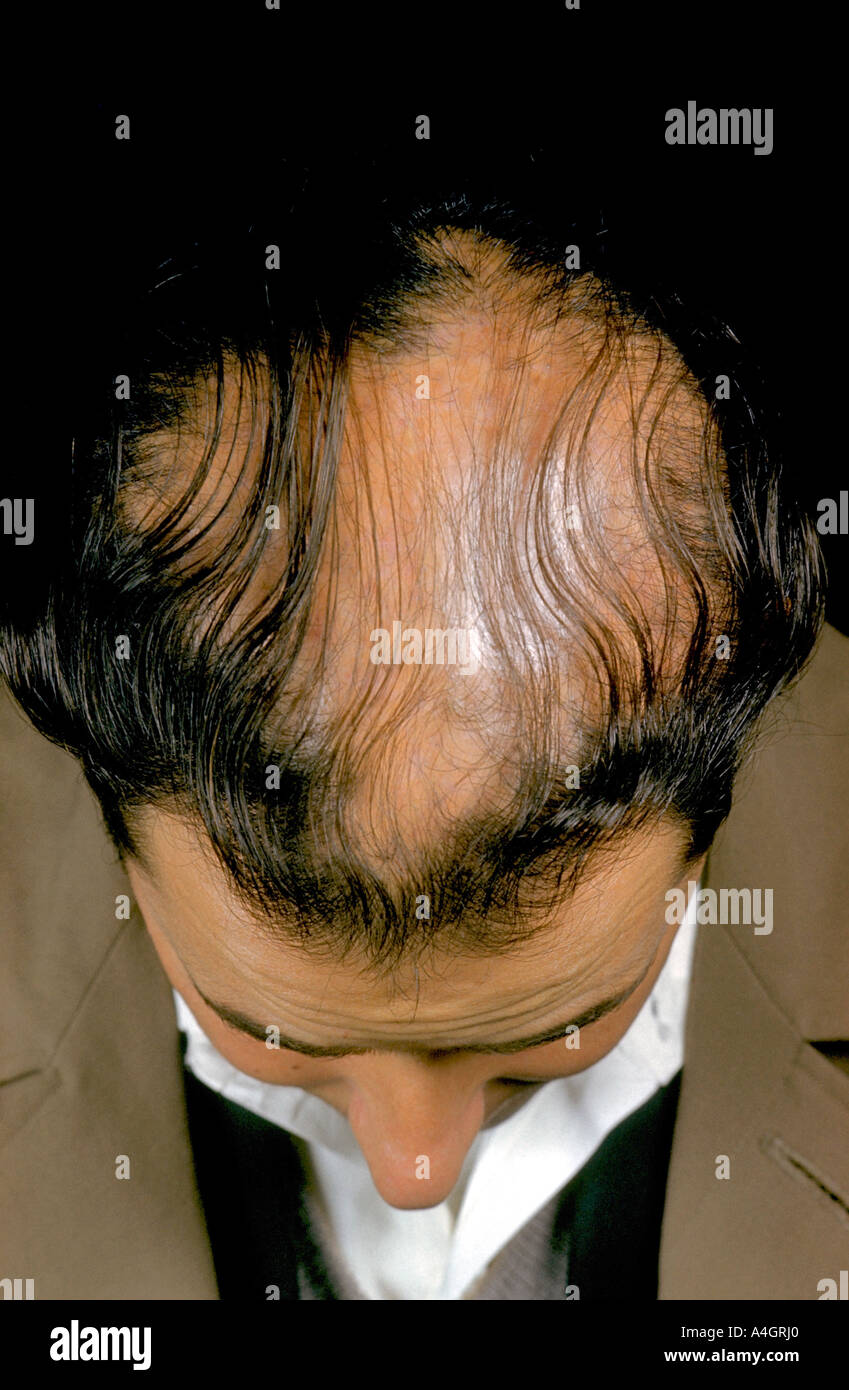 Male pattern baldness is the most common type of hair loss in men Stock  Photo - Alamy