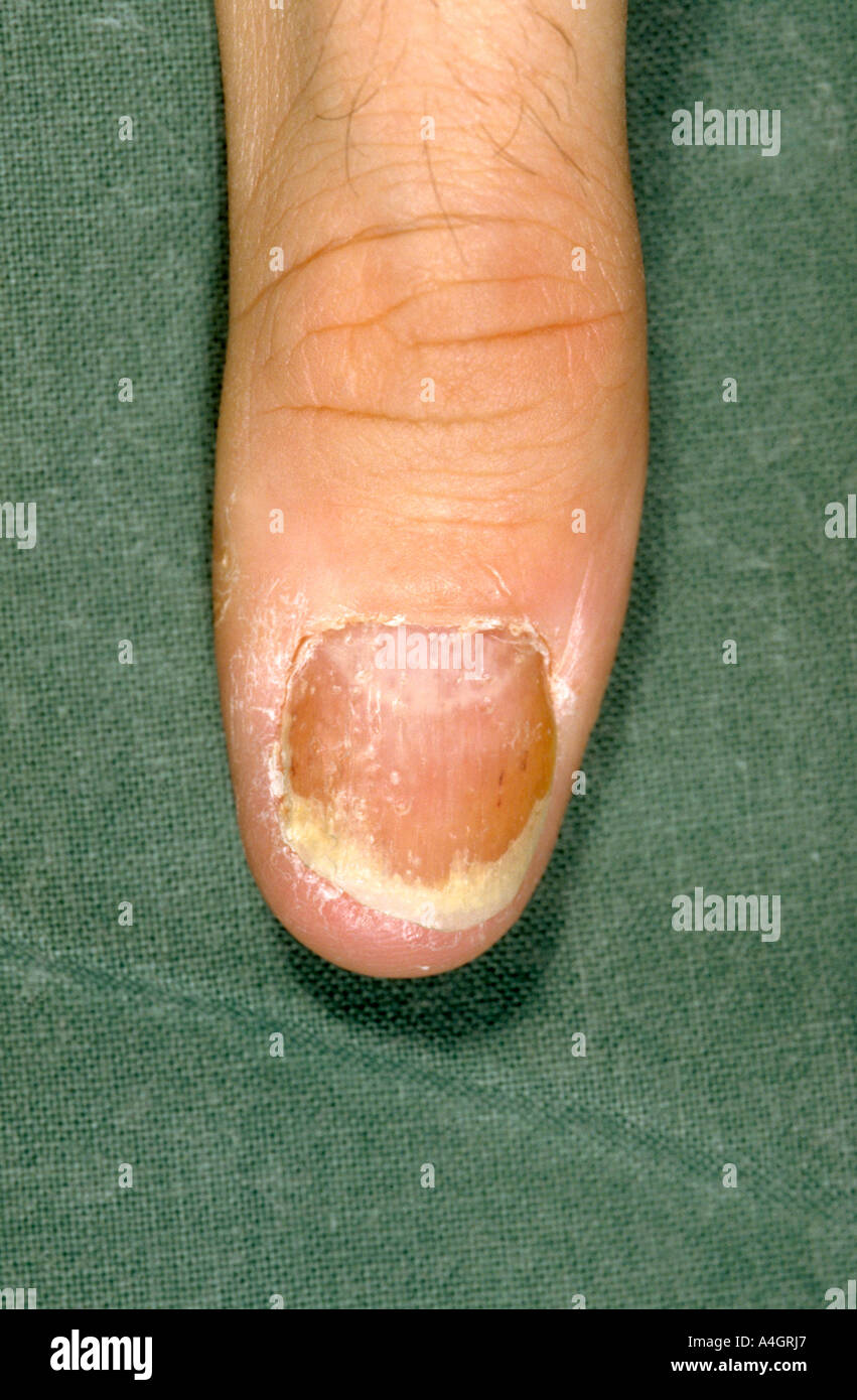 Nail dystrophy comes in many forms. Trauma to the nail, as in bitting or sucking, can cause nail trauma and dystrophy Stock Photo