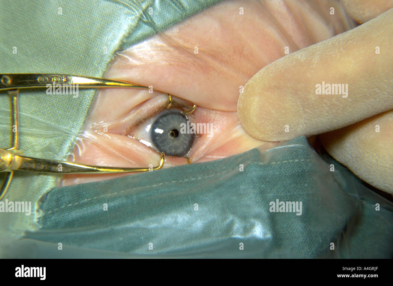 A squint is the common name for strabismus Stock Photo