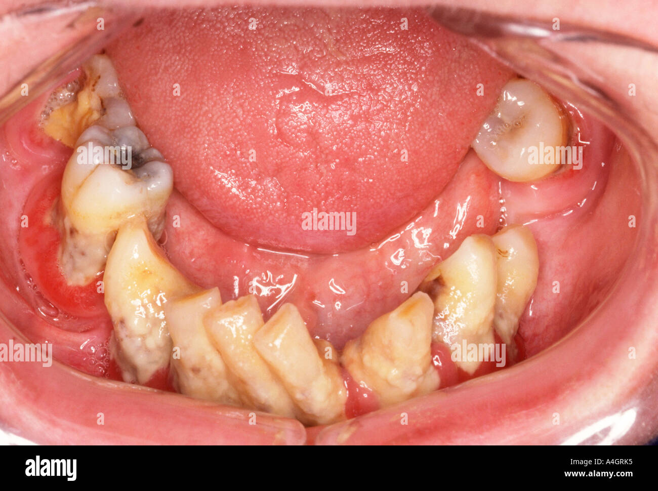 A periodontal abscess is a localised purulent inflammation of the
