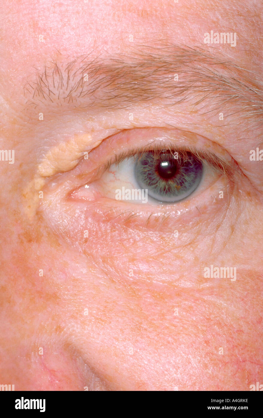 Debulking of Cholesterol Xanthomas of the Hand for Cosmetic Reasons |  Semantic Scholar, image size:876x1390