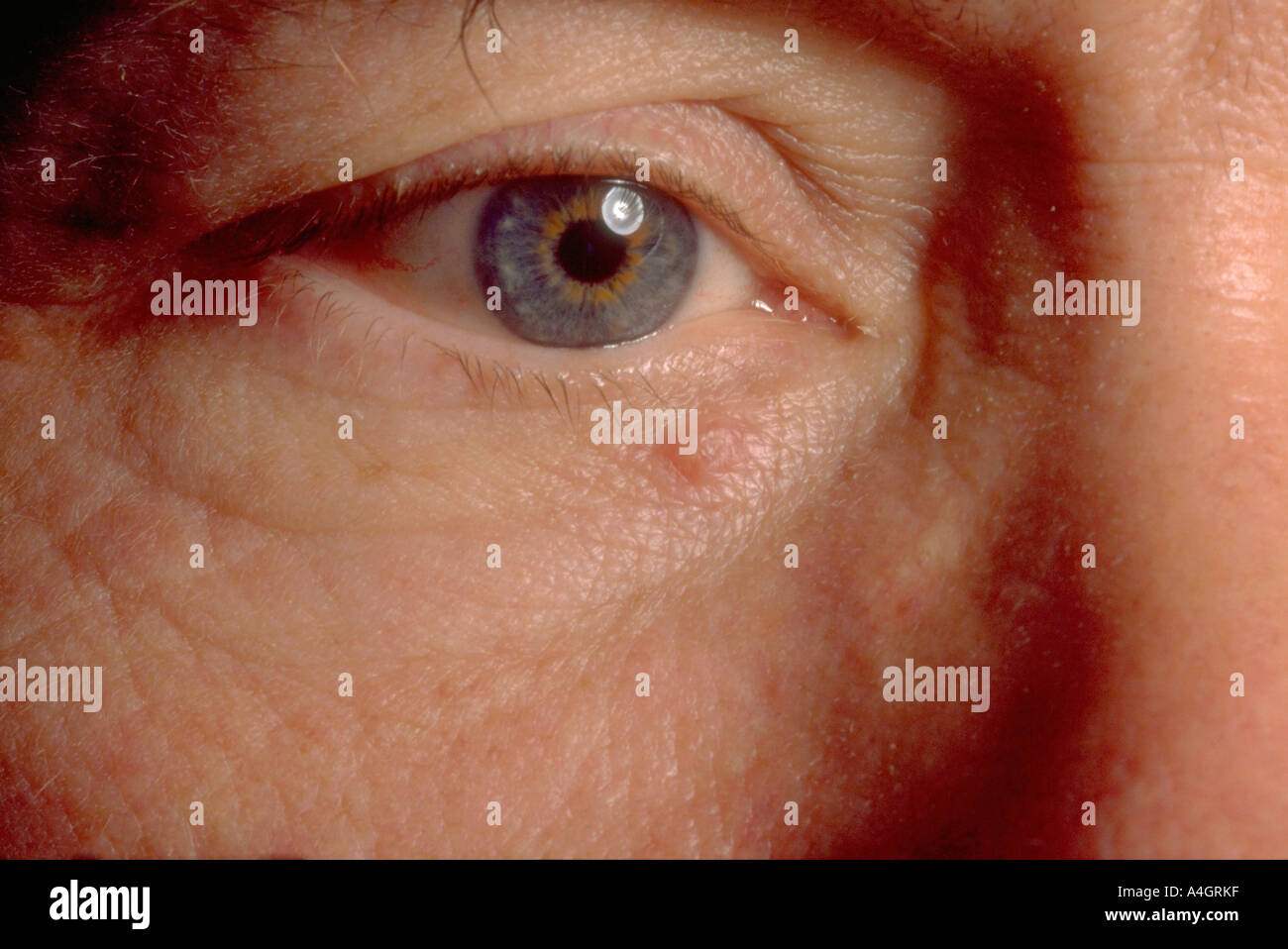 Eyelid basal cell carcinoma hires stock photography and images Alamy