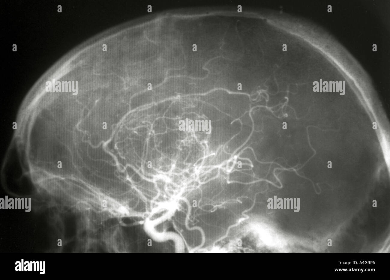 An angiogram x-ray of the skull showing a secondary melanoma Stock Photo
