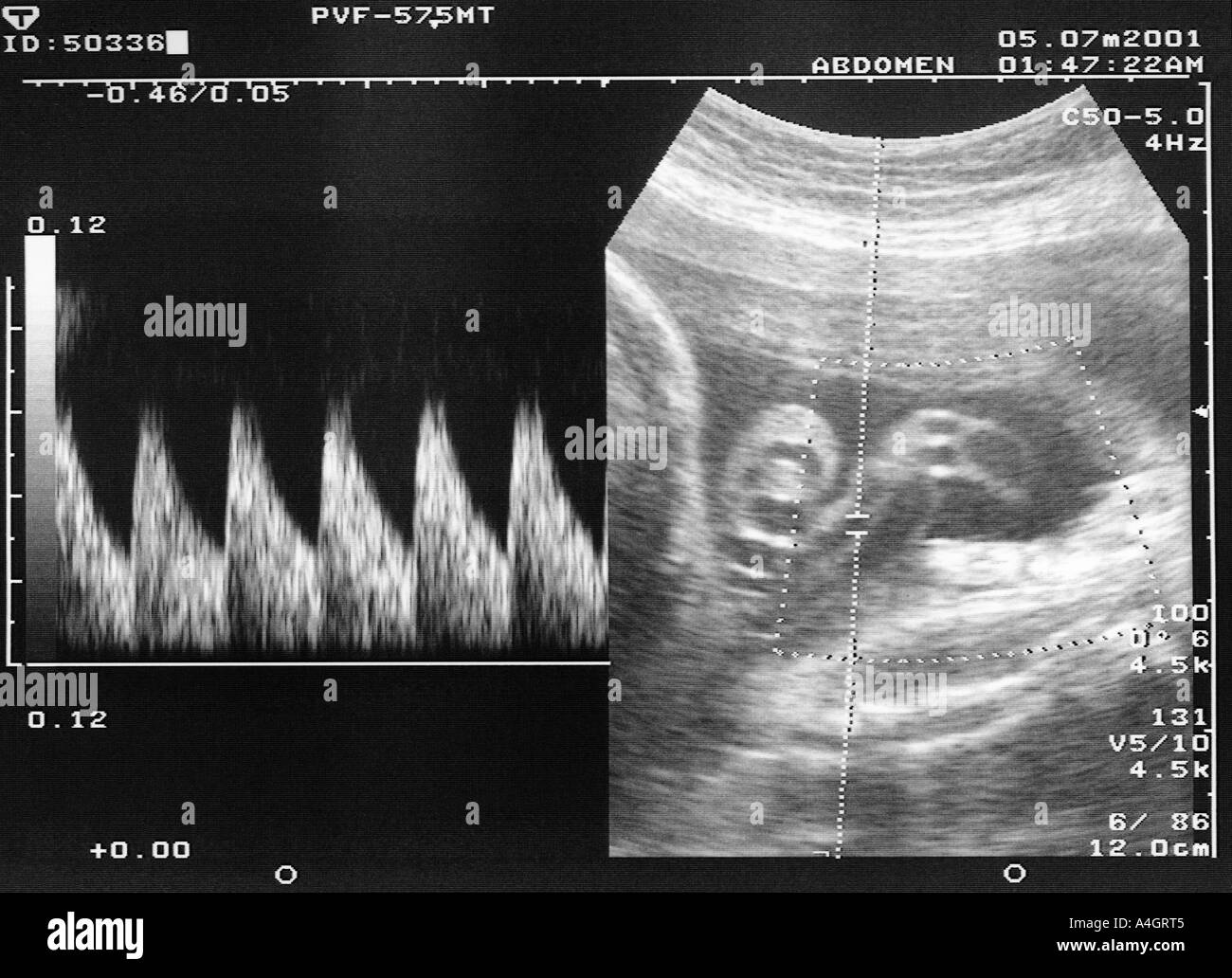 Uterine Artery Doppler Ultrasound