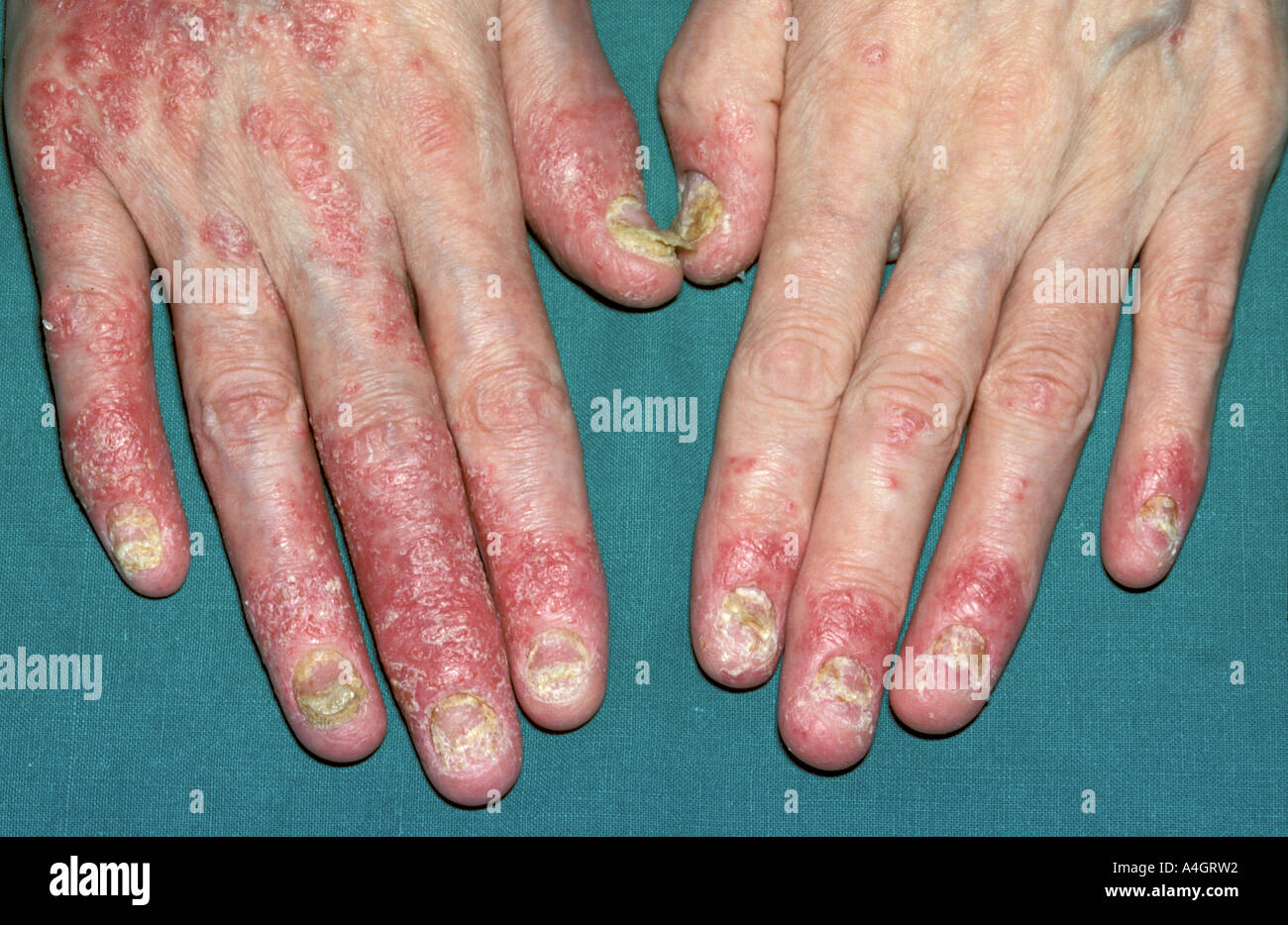 Psoriatic arthritis is a condition that causes swelling and pain in and around the joints Stock Photo