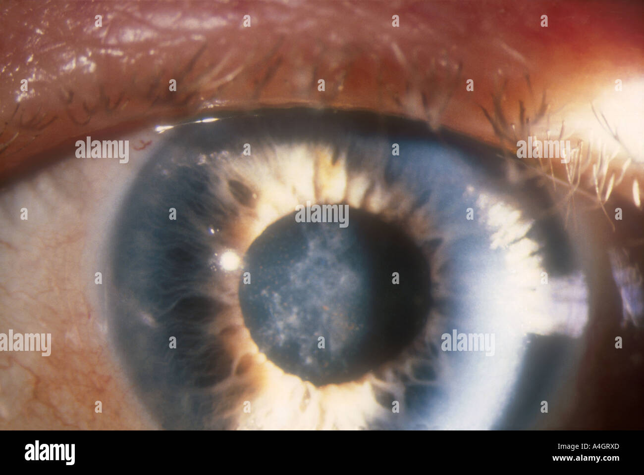 Вторичная катаракта после операции. Вторичная пленчатая катаракта. Шары Эльшнига вторичная катаракта. Лазерная дисцизия вторичной катаракты.