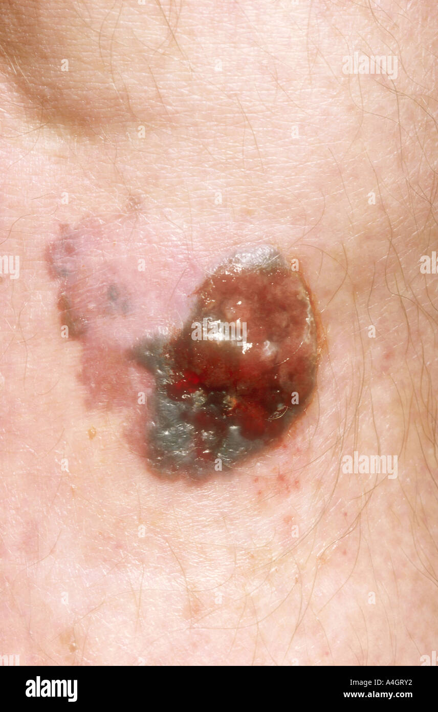 Nodular malignant melanoma hires stock photography and images Alamy