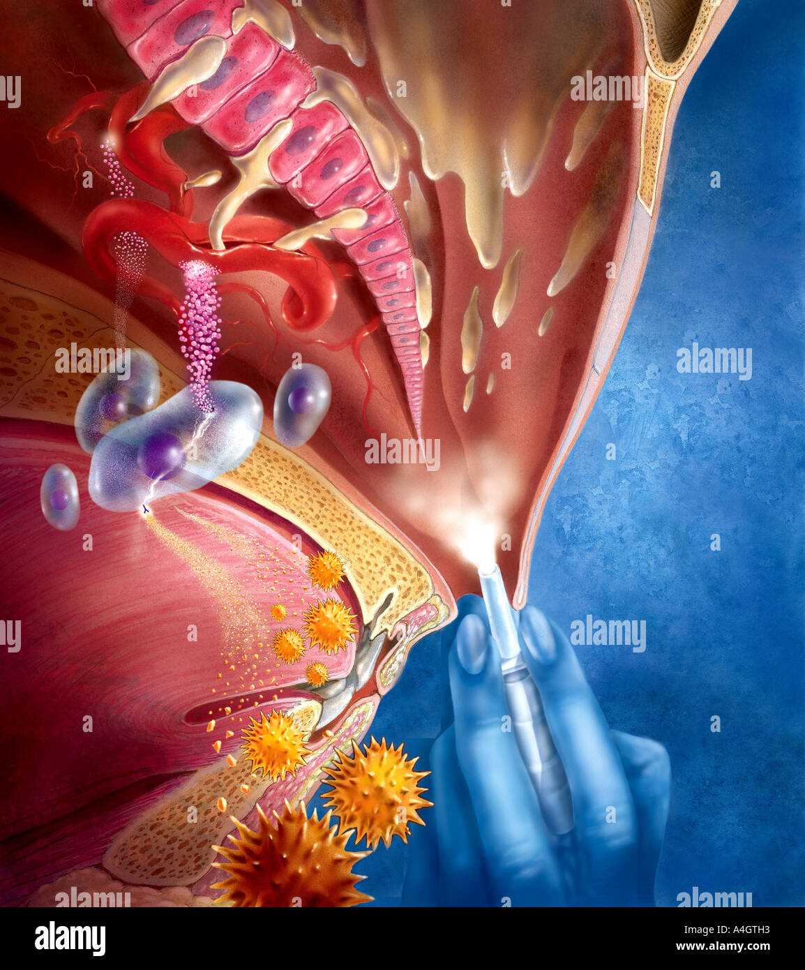 An illustration showing the acute and late phase allergic reaction in the nasal turbinates Stock Photo