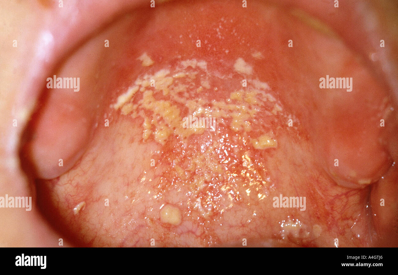 A photograph of a baby with oral thrush, an infection of yeast fungus, Candida albicans Stock Photo