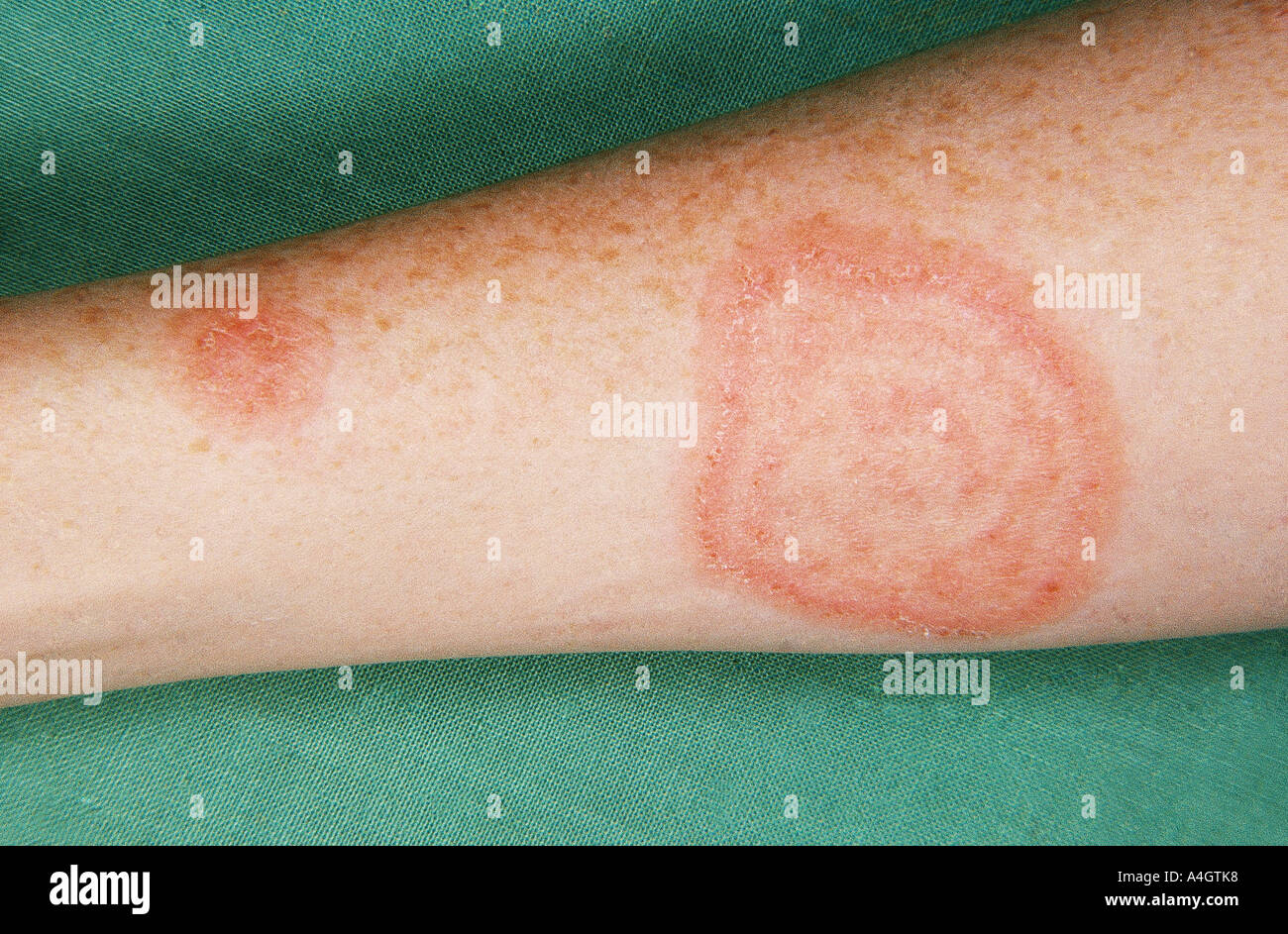 Ringworm is a skin infection caused by a fungus Stock Photo