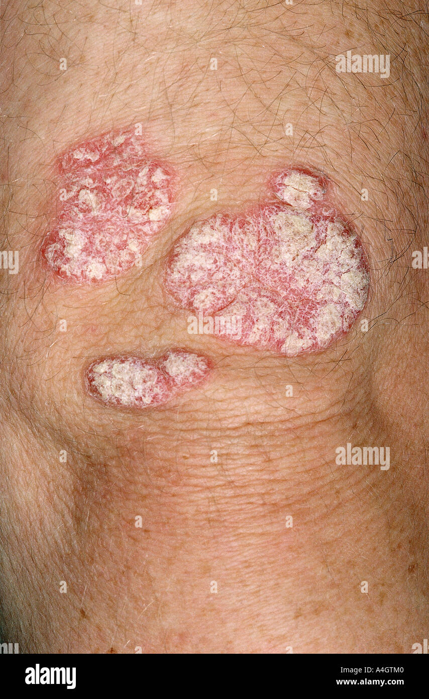 Plaque psoriasis on the knee Stock Photo Alamy