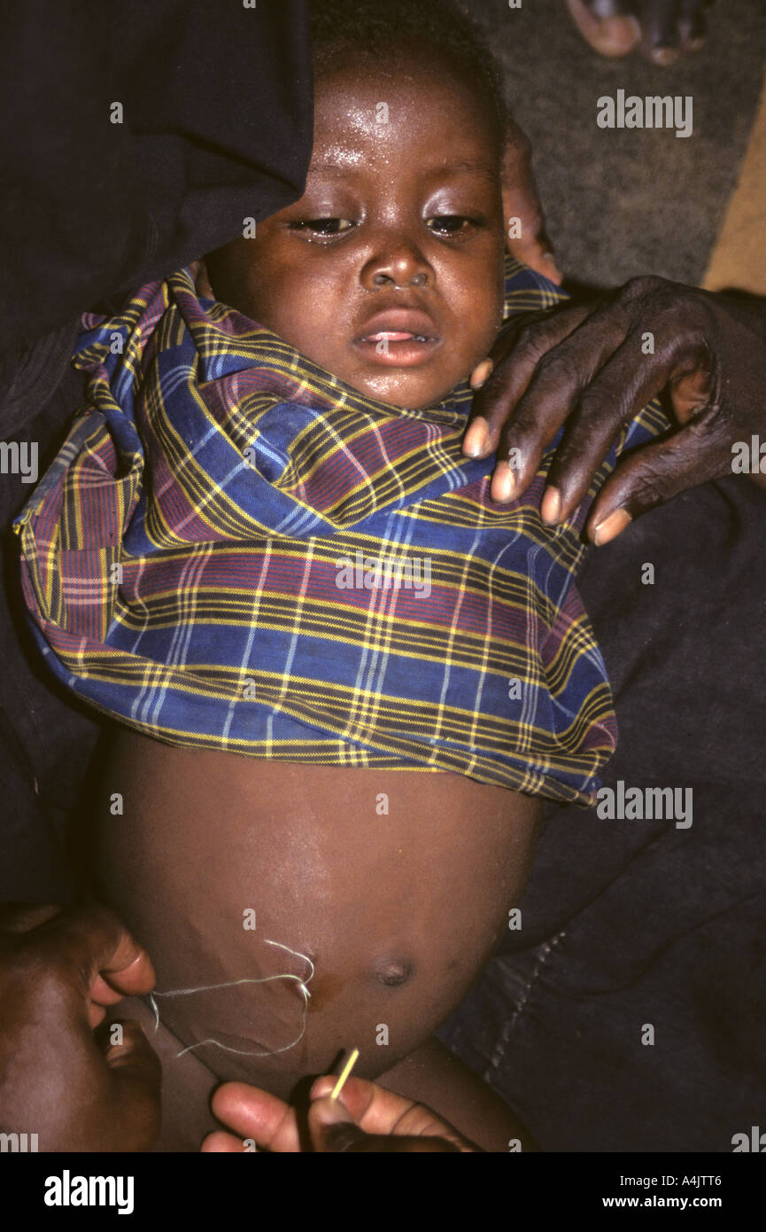 Doctors Tying Thread Around Emerging Guinea Worm, Niger. Stock Photo
