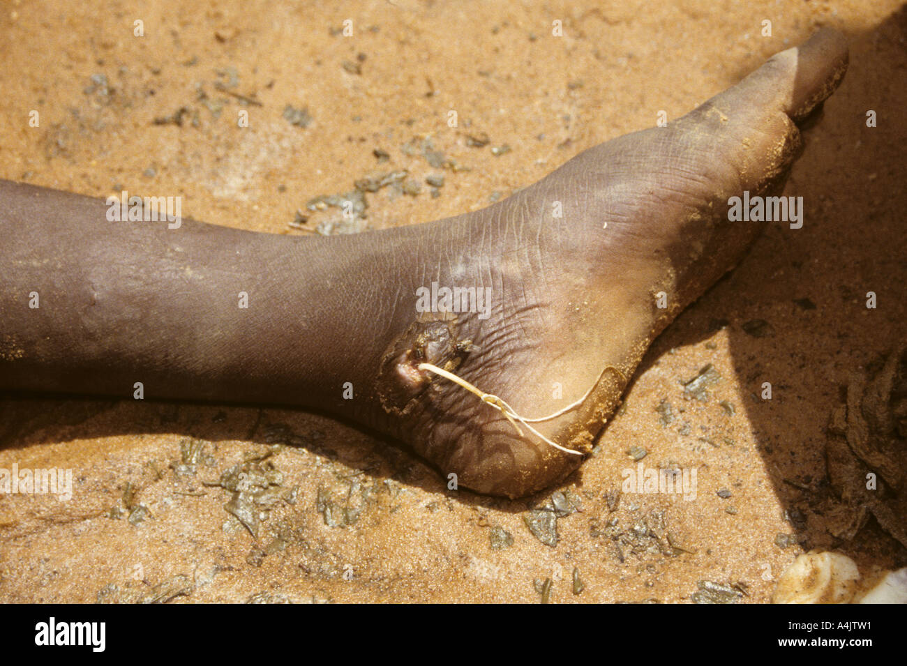 Thread tied around Emerging Guinea Worm, Niger. Stock Photo
