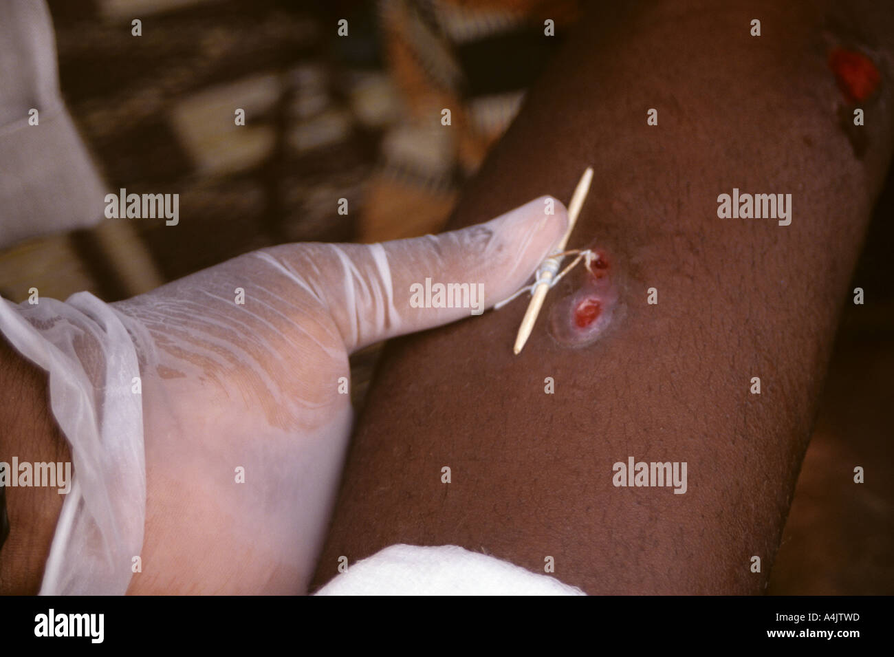 Looping Thread around Emerging Guinea Worm, Niger. Stock Photo