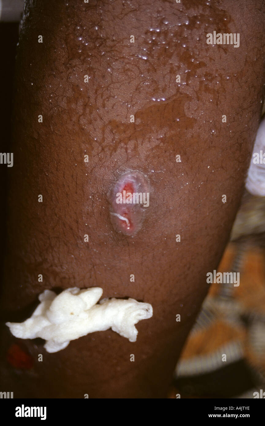 Coaxing Guinea Worm to Emerge, Niger. Stock Photo
