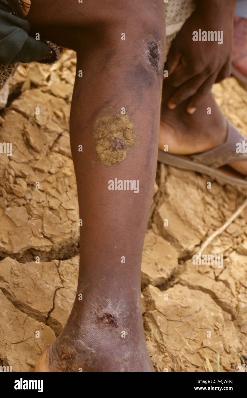 Bankilare, Niger, West Africa. Cow dung covers open sores caused by Guinea worm, Niger. Stock Photo