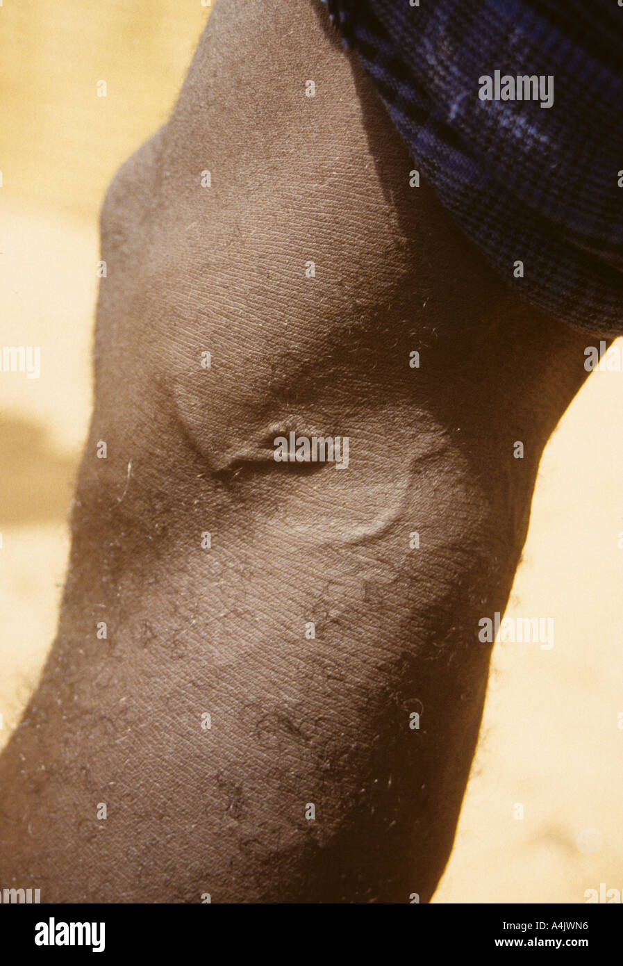 Guinea Worm Under Skin Behind Knee, Near Bankilare, Niger, West Africa. Stock Photo