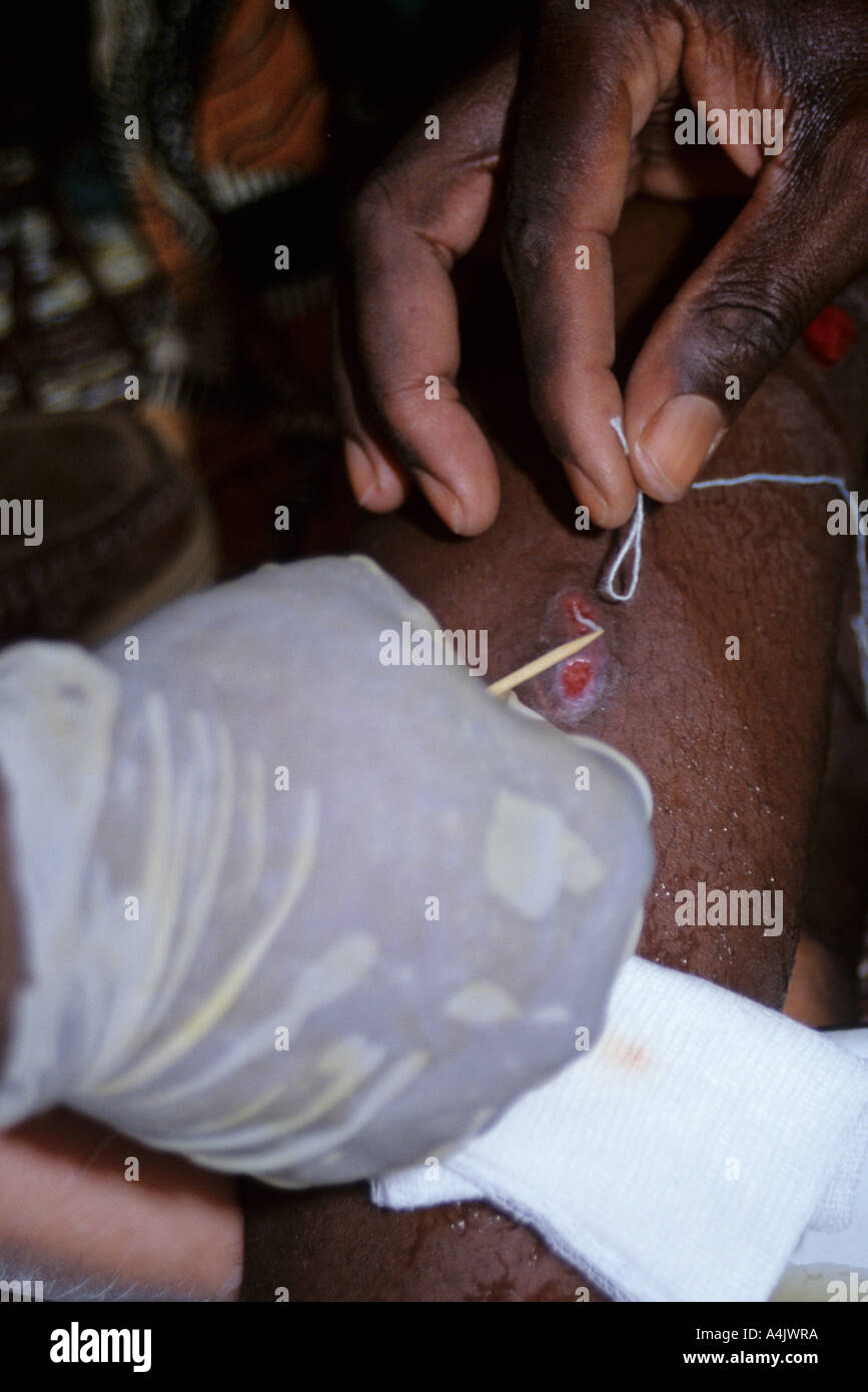 Looping Thread Around Guinea Worm Emerging from Leg, Near Tera, Niger, West Africa. Stock Photo